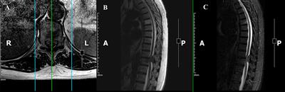 An unusual presentation of ossified spinal meningioma: case report and literature review